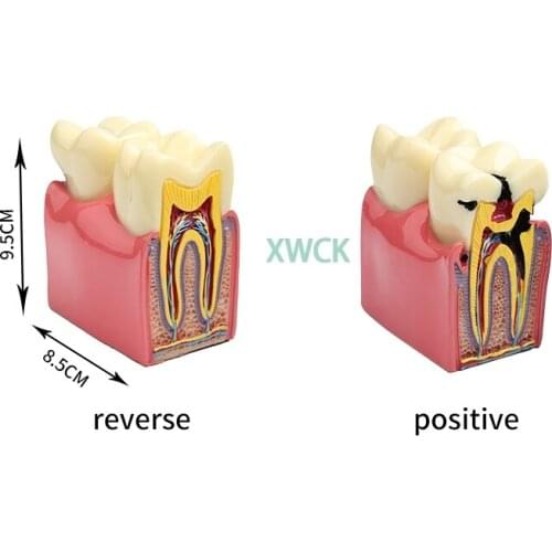 1Pcs 6 Times Dental Caries Comparsion Models Tooth Decay Model For Dental Study Teaching Dental Anatomy Education Teeth Model