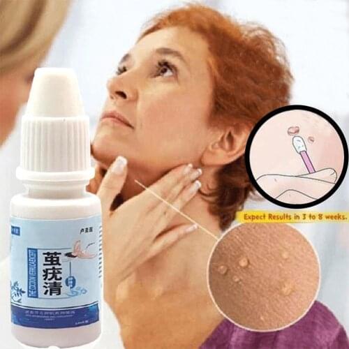 Genital Wart Treatment Papillomas Removal Of Warts Verruca Skin From Remedy Against Anti Removing Liquid Remover Moles Z4E5