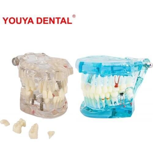 Dental Implant Model Dentistry Dentist Disease Tooth Implant Model Teeth With Restoration Bridge For Medical Science Teaching