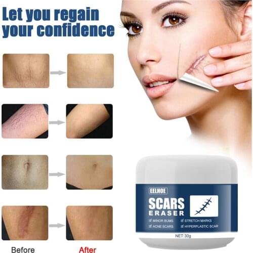 20g Powerful Remove Pregnancy Scars Cream Stretch Marks Creams Treatment Repair Winkles Firming Body Burn Skin Repair Cream