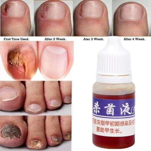 10ML Nail Repair Serum Fungal Nail Treatment Removal Onychomycosis Toe Nail Nourishing Hand and Foot Care Disinfect Liquid