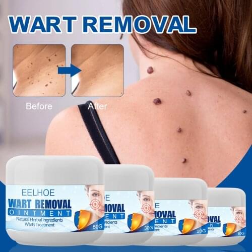 Wart Remover Safe Painless Skin Genital Wart Treatment Medical kill Remover Skin Tag Mole Genital Wart Remover 100% All Natural