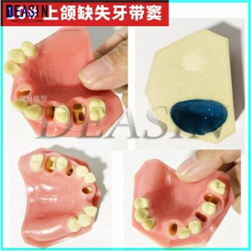 1 pc x High Quality Dental Overdenture Removable Interior Mandibular Lower Teeth Model Mandibular With Implant