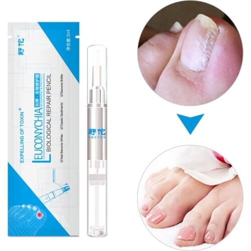 Toe Nail Fungus Treatment 3mL Onychomycosis Paronychia Anti Fungal Nail Infection Chinese Herbal Therapy