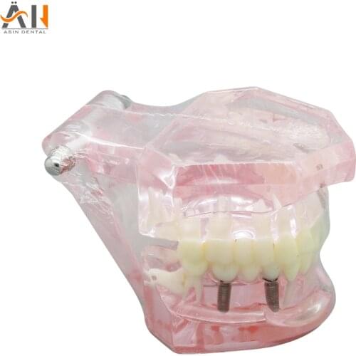 Teeth Model Dental Implant Disease Restoration Medical Science Disease Teaching Study school quality Tooth model Dentist use