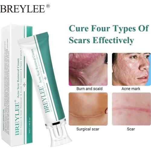 BREYLEE Scar Cream Scar Stretch Marks Removal Fade Acne Old & New Scars Pimples Treatment Whitening Moisturizing Cream Skin Care
