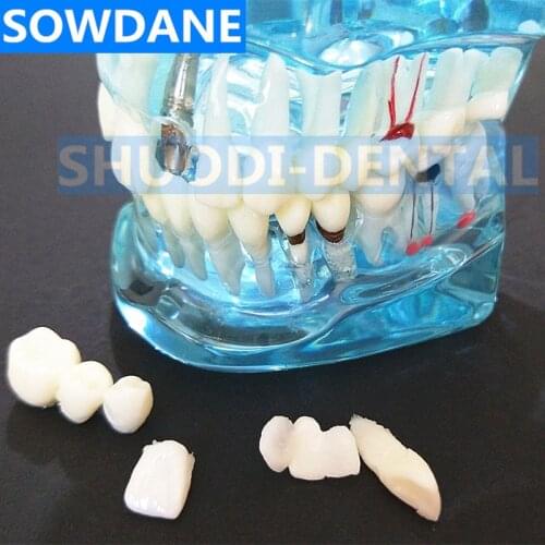 Hot Dental Implant Disease Teeth Model With Restoration Bridge Tooth Dentist For Medical Science Dental Disease Teaching Study
