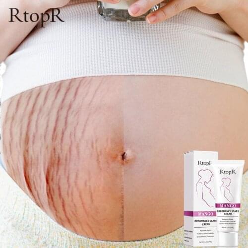 Mango Remove Pregnancy Scars Acne Cream Stretch Marks Treatment Maternity Repair Anti-Aging Anti-Winkles Firming Body Creams
