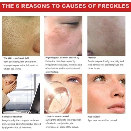 Powerful Whitening Freckle Cream Chinese Herbal Plant 40g Whitening And Remove Face Skin Freckles Spots Dark Cream Cream J6U9