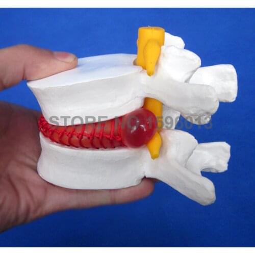 Amplified Lumbar vertebra model Herniated Disc model