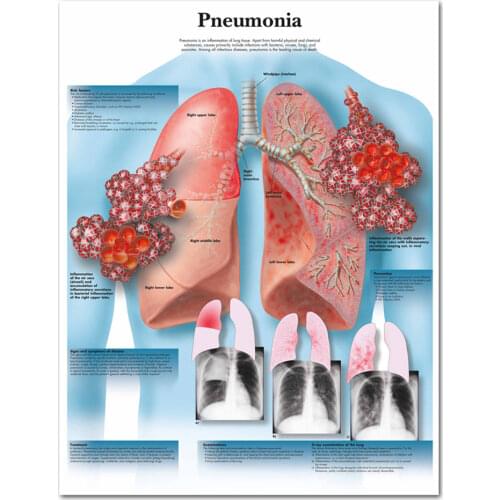 WANGART Anatomical Charts Posters Pneumonia Chart Poster Canvas Painting Wall Pictures for Medical Education
