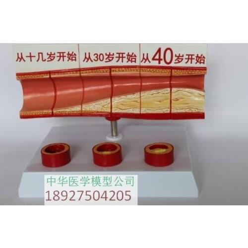 Different age blood vessel anatomical model vascular atherosclerosis anatomy model