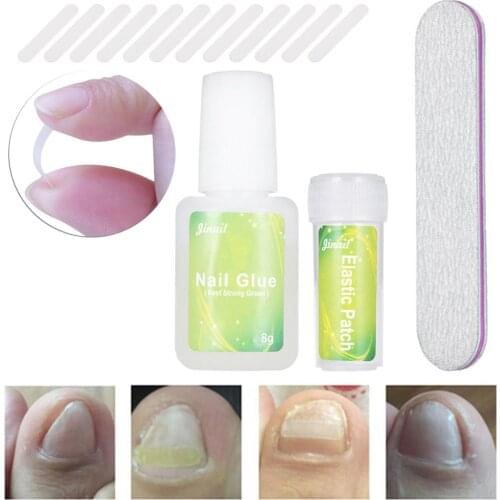 New 12PCS/Bottle Ingrown Toenail Correction Tool Set Ingrown Toe Nail Pedicure Elastic Patch Straightening Clip Brace with Glue