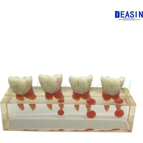 New Dental Oral Teaching Model Endodontic Treatment Model Demonstrating the process of deciduous teeth