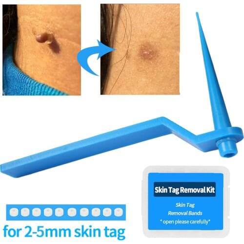 10PCS Tagband Skin Tag Removal Tool Kit Medical Skin Tag Kill Face Care with Cleansing Swabs Adult Mole Wart Black Head Remover