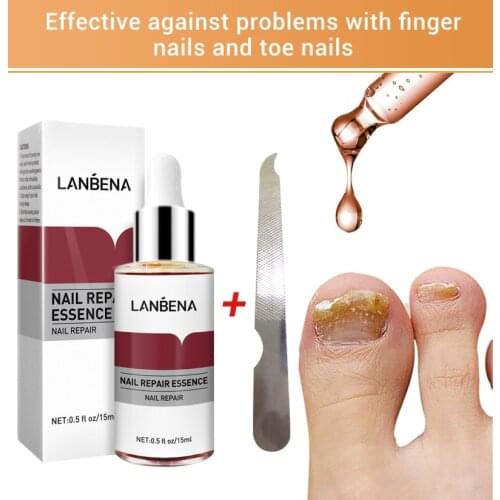 LANBENA Fungal Nail Repair Essences Serum Anti Infections Paronychia Onychomycosis Treatments Care Foot Nail Fungus Removal Gel