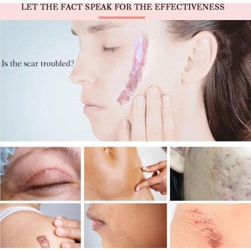 Lavender scar repair cream acne scar stretch marks corrector skin care 1pcs pigmentation calming anti-allergic A3I0