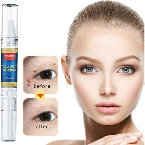 Skin Tags & Moles Warts Corn Remover - Restore Skin Health and Beauty