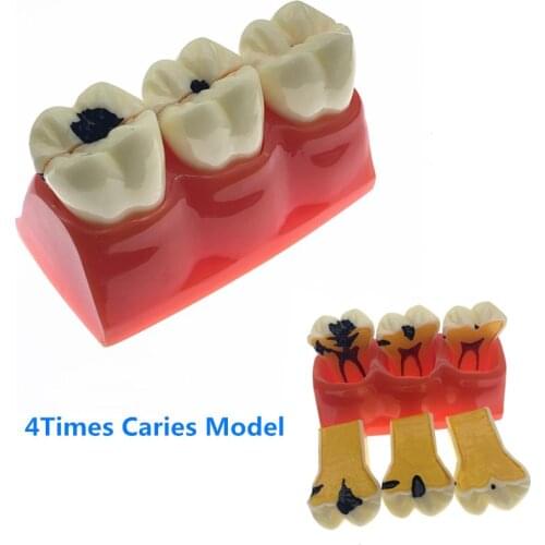 1 Piece Dental Caries Removable Teeth Tooth Model Learn Study Model 4:1 Size