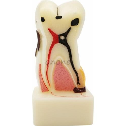 1pcs Four Times Size Dental Pathology Teeth Model, Dental Caries, Calculus, Pulp stones, Occlusal Tooth Wear