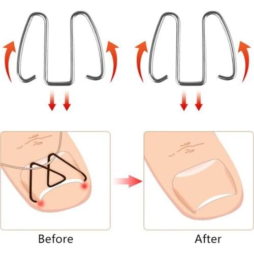 1Box Ingrown Toe Nail Correction Wire Fixer Pedicure Paronychia Recover Embed Toenail Correction Lifter Tool Kit Inset Buckle