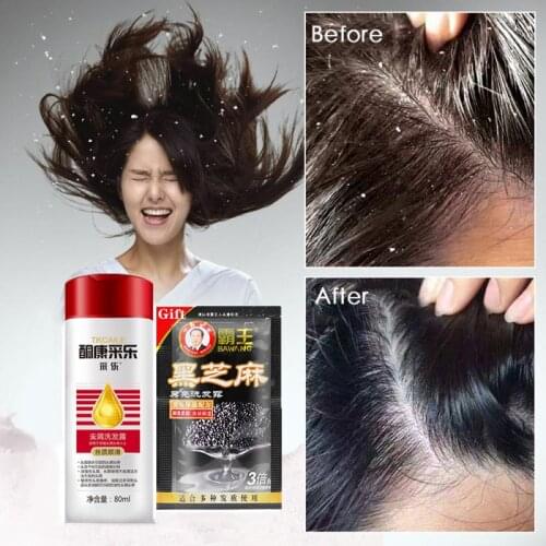 Control Oil Relieve Itching Dandruff Shampoo Washing Anti Flakes Scalp Anti-Dandruff Hair Shampoos Anti-Mite Reducing Dandruff