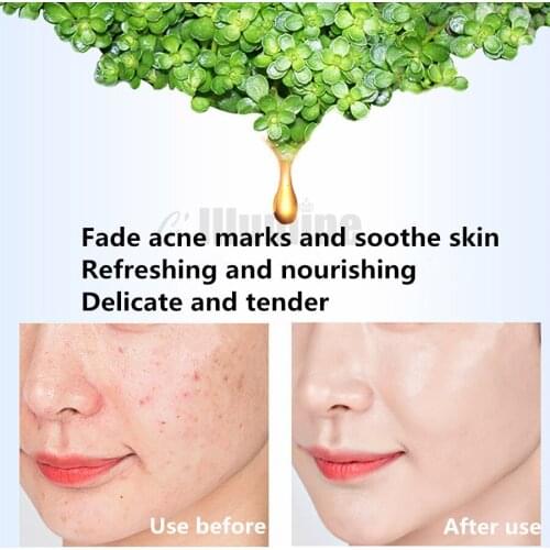 Skin Care Day Cream Mint Anti Allergy Repair Ice Crystal 1000g Repair Acne Recovery Elastic Cosmetics OEM Beauty Salon Equipment