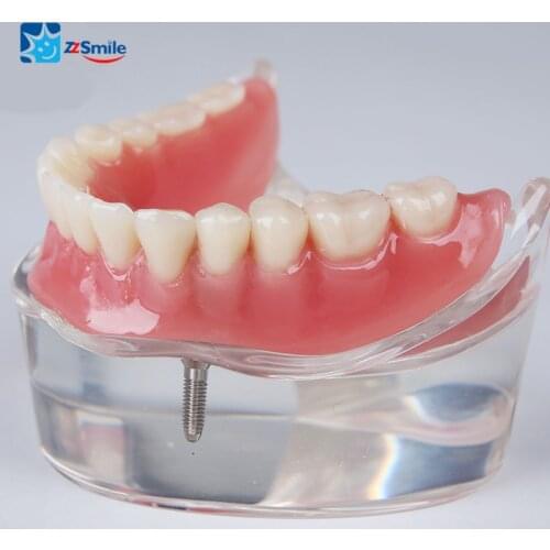 Dental M6002 Overdenture Model Dental Teeth Model