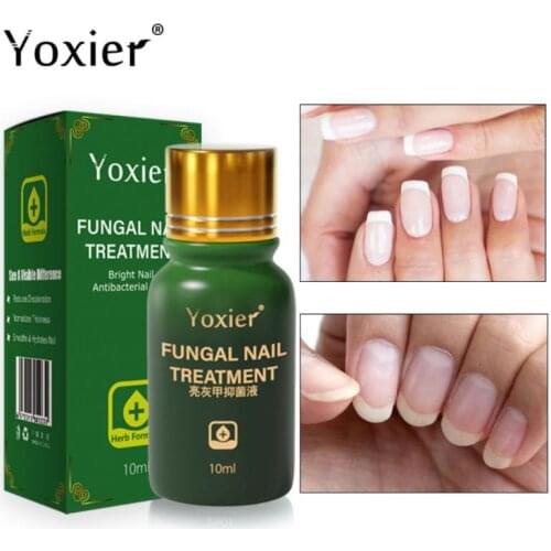Yoxier Nail Fungal Treatment Feet Care Essence Nail Foot Whitening Toe Nail Fungus Removal Gel Anti Infection Paronychia TSLM1