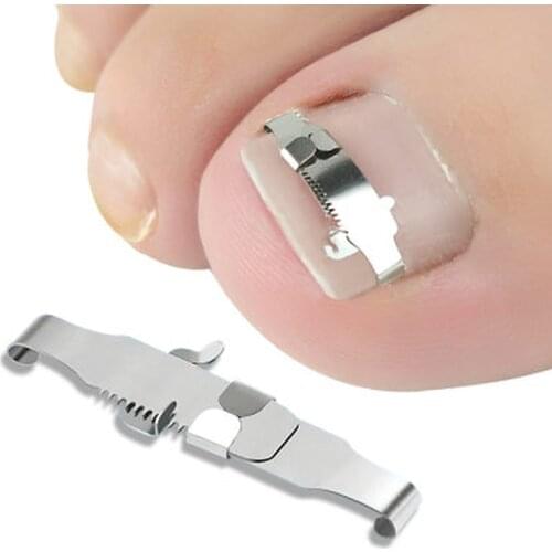 Ingrown Toenail Corrector Orthotic Nail Fixer Toenail Correction Treatment Foot Care Tools Recover Embed Tool Corrector Pedicure