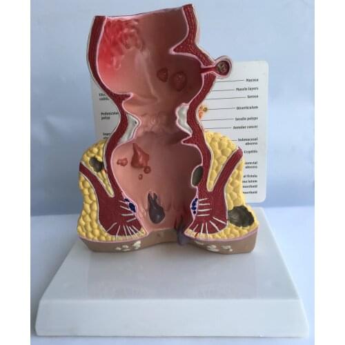 Human Anorectal Pathological Model Anorectal Fistula Fissure Lesion Model In Rectal Hemorrhoids Medical Anorectal Model Models
