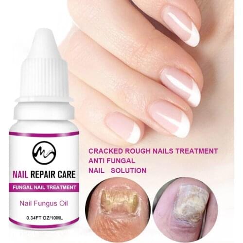 Minch Fungal Nail Treatment Oil Onychomycosis Paronychia Anti-Fungal Nail Infection Herbal Toe Fungus Foot Repair Essence Care