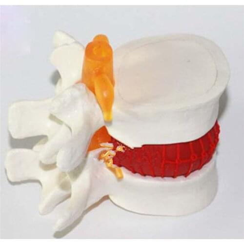 Human Lumbar Disc Herniation Model Demonstration Model of Lumbar Vertebral Spine Model Medical Teaching Resources
