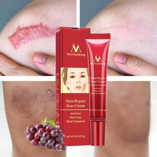 Acne Scar Removal Cream Acne Spots Acne Pigmentation Corrector Whitening Face Cream Anti Scar Stretch Marks Repair Skin Care