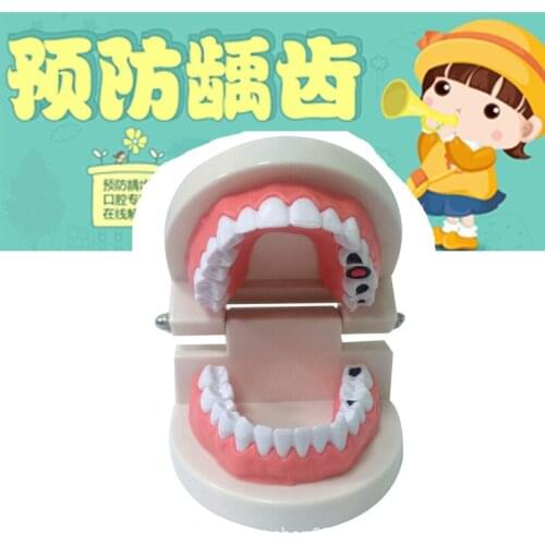 ABS PVC Dental Model Oral Instrument Tools Dental Consumables Tooth Decay Model Medical Care Teaching Aids Teeth Model
