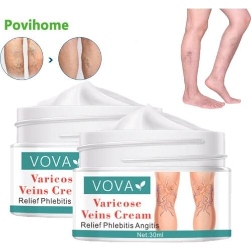 1Pcs 30ml Original Varicose Veins Cream Treat Vasculitis Phlebitis Remove Spider Swelling Pain Relief Ointment Medical Plaster