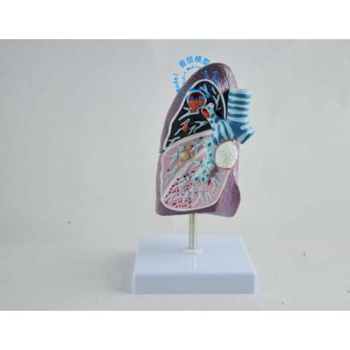 Free shipping&Pathology lung model, Department of internal medicine model, pulmonary anatomy, respiratory system model