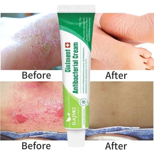 Herbal Ointment Antibacterial Cream Eczema Psoriasis Cream Anti-itch Relief Eczema Skin Rash Urticaria Desquamation Treatment