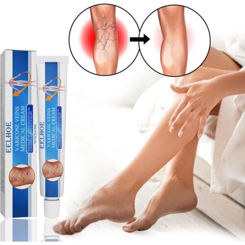 20G Varicose Veins Treatment Cream Natural Original Vasculitis Phlebitis Spider Pain Relief Ointment Medical Plaster