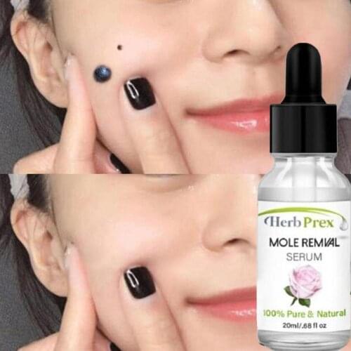 Dilute Wart Mole Solutions Serum Improve Skin Metabolism Serum Reduce Removal Spots Black Mole Essential 20Ml Melanin Oil H7C5