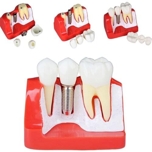 Dental Implant Teeth Model M2017 screw Detachable 4 Times Teeth Model Magnet Implant Analysis Crown Bridge Dental Teaching model
