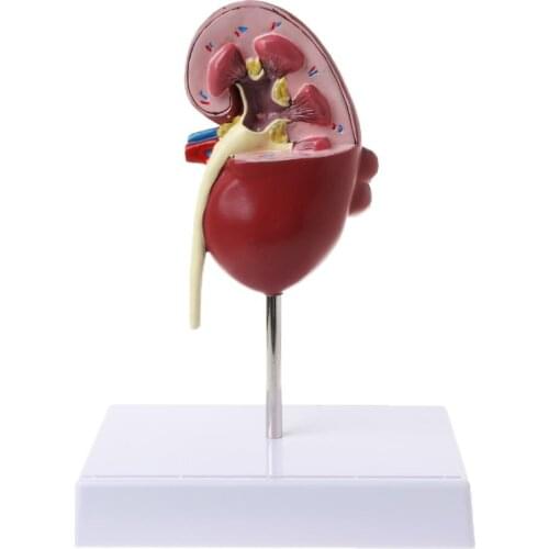 Life Size Human Kidney Diseased Model Anatomical Anatomy Diseased Pathological Stone Organ Teaching Supplies M17F