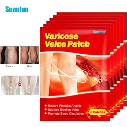 Sumifun 6Pcs Varicose Veins Plaster Treatment Angiitis Spider Leg Vasculitis Phlebitis Care Removal Patch Chinese Herbal Patches