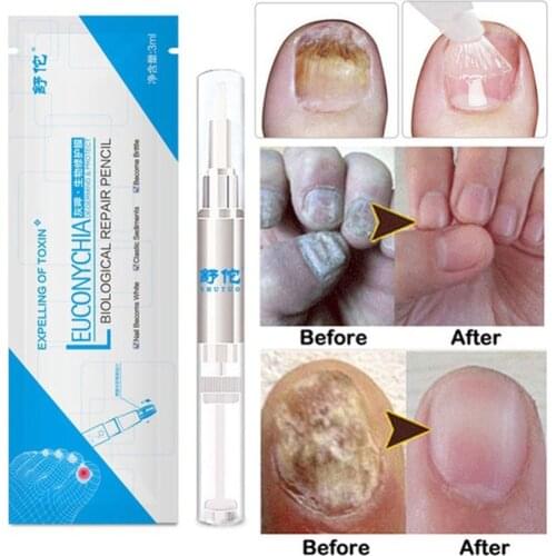 3ml Nail Treatment Pen Fungal Nail Treatment Essence Liquid Whitening Toe Nail Fungus Removal Nail Art Tool