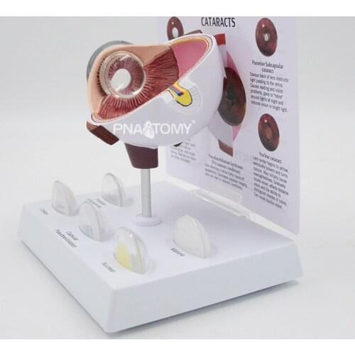 Oversized Cataract Eye Anatomical Model Human Eye Anatomy Cornea and Lens Medical Sciences Educational Equipment Teaching Tool