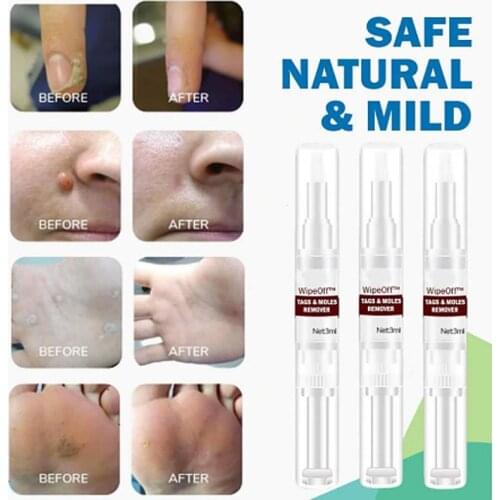 1PC Skin Tag Remover Pen Natural Health Mole Nevus Wart Skin Tag Foot Corn Warts Treatment Skin Tag Removal TXTB1