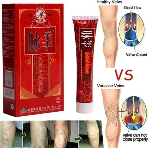 Varicose Veins Treatment Cream Effective Vasculitis Phlebitis Spider Veins Varicosity Angiitis Treatment Ointment Herbal Cream