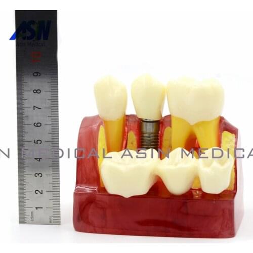 MACRO IMPLANT TEETH MODEL CROWN BRIDGE DEMOSTRATATION TEETH TOOH TYPODONT DENTOFORM
