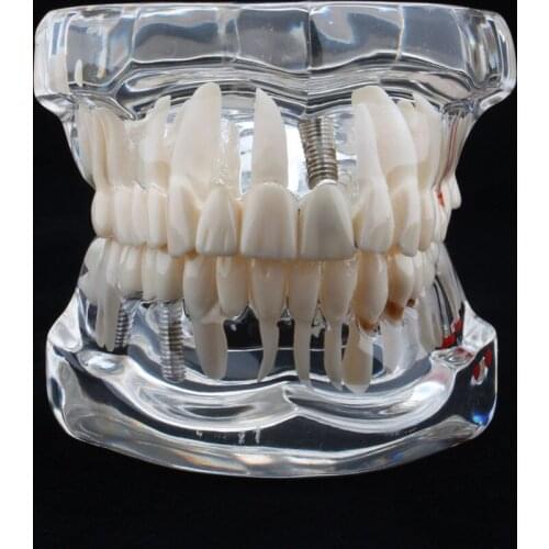 Dental display model dentist clinic stomatologist research model transparent resin research dental structure repair correction