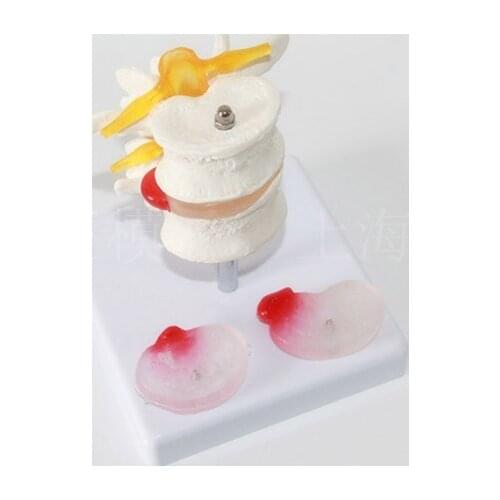 Two Section of lumbar disc disease model umbar disc herniation of intervertebral disc disease model spine model